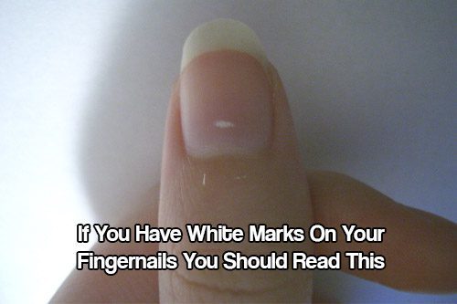If You Have White Marks On Your Fingernails You Should Read This SHTF 