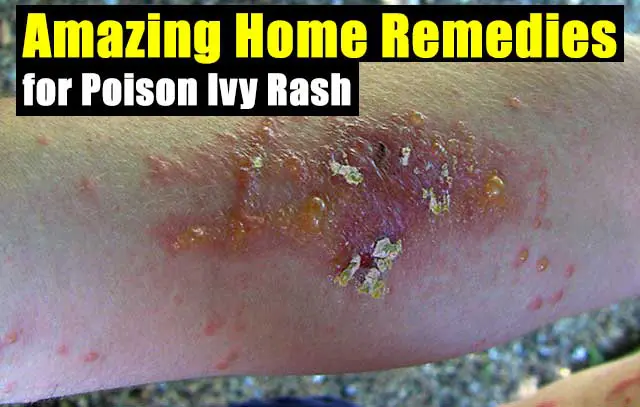 Amazing Home Remedies for Poison Ivy Rash - SHTF Prepping ...