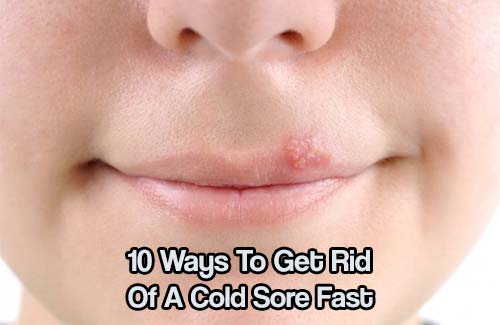 10 Ways To Get Rid Of A Cold Sore Fast - Check out these awesome 10 Ways To Get Rid Of A Cold Sore Fast. All of the methods are natural and you probably have them laying around the house.