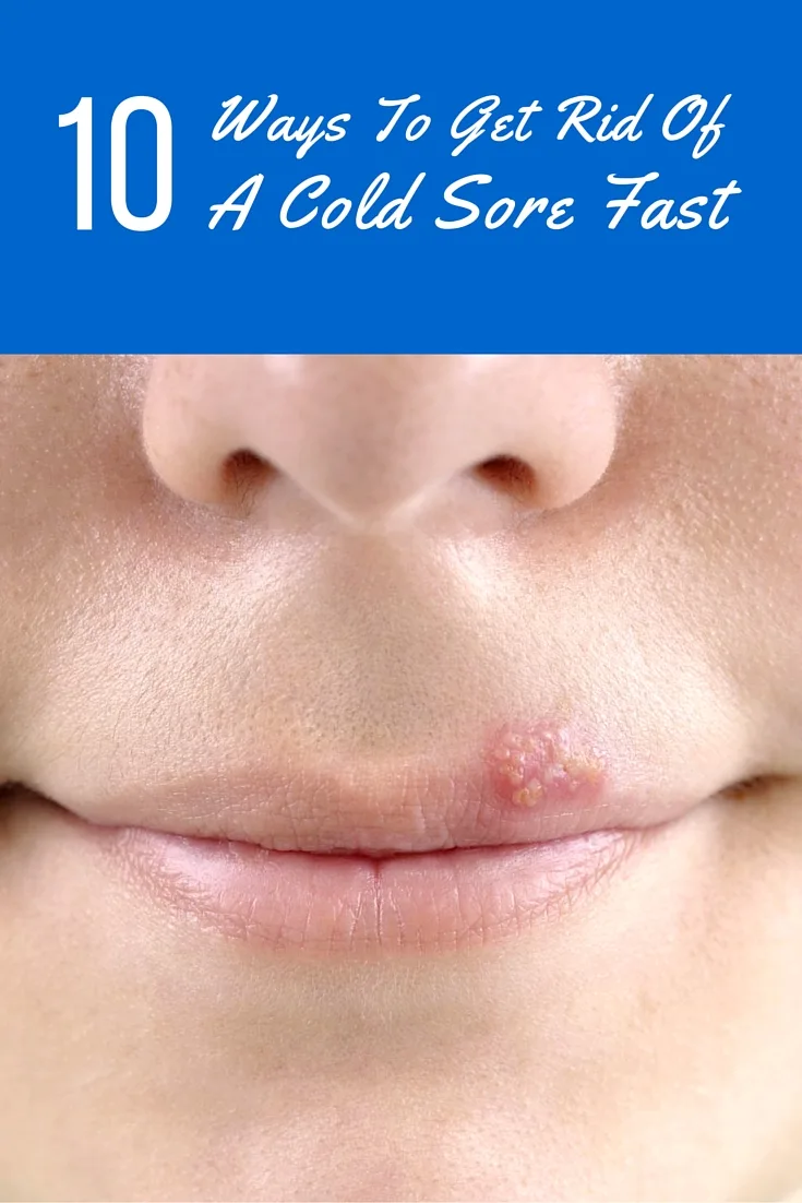 10 Ways To Get Rid Of A Cold Sore Fast - Check out these awesome 10 Ways To Get Rid Of A Cold Sore Fast. All of the methods are natural and you probably have them laying around the house.