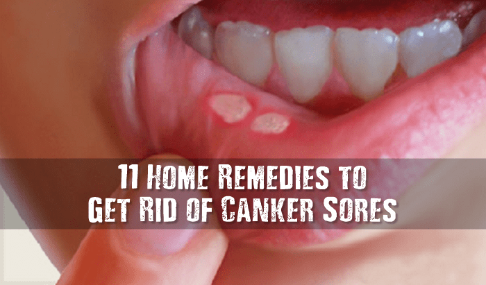 How to get rid of canker sores on tongue at home