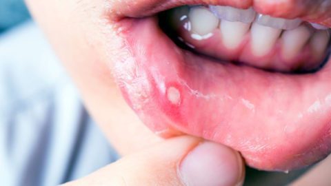11 Home Remedies to Get Rid of Canker Sores