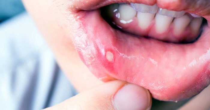 11 Home Remedies to Get Rid of Canker Sores - A canker sore is a very common oral condition that normally develops inside the lining of the mouth or the upper throat. A canker sore is not contagious and its exact causes are unknown.