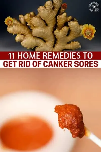 11 Home Remedies to Get Rid of Canker Sores - A canker sore is a very common oral condition that normally develops inside the lining of the mouth or the upper throat. A canker sore is not contagious and its exact causes are unknown.