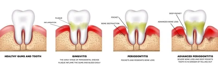 Periodontal infection is an infection in the gums and soft tissue around the teeth.