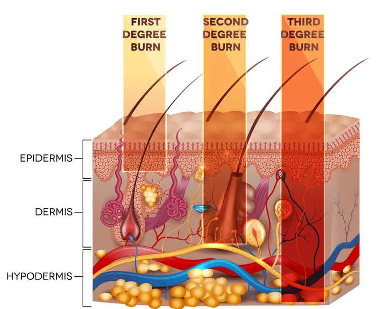 Illustrations of first-, second-, and third-degree skin burn classifications