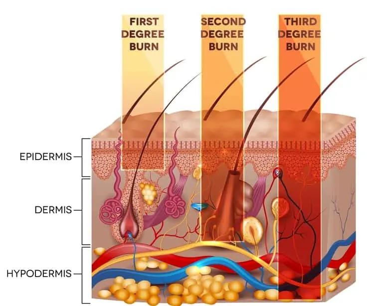 Illustrations of first-, second-, and third-degree skin burn classifications
